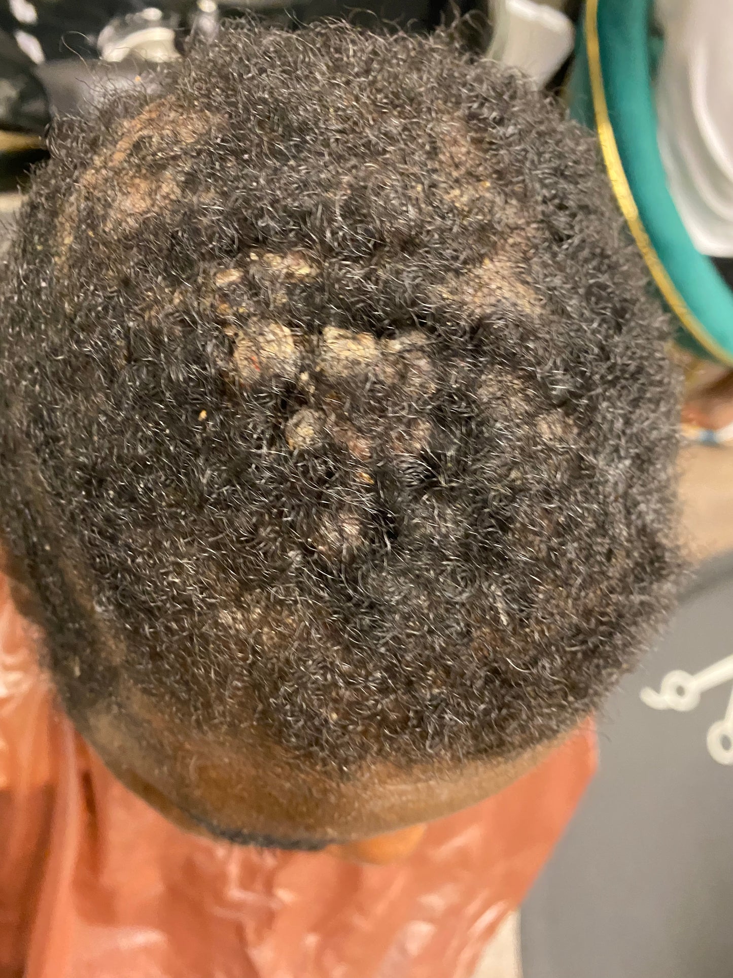 Scalp Eczema and Psoriasis Treatment